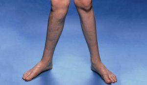 زانوی ضربدری چه عوارضی برای کودکان و بزرگسالان دارد؟