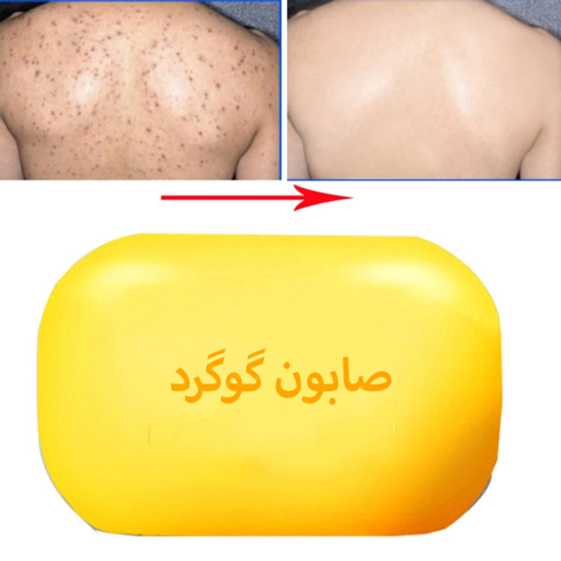 صابون گوگرد ضد جوش اژه