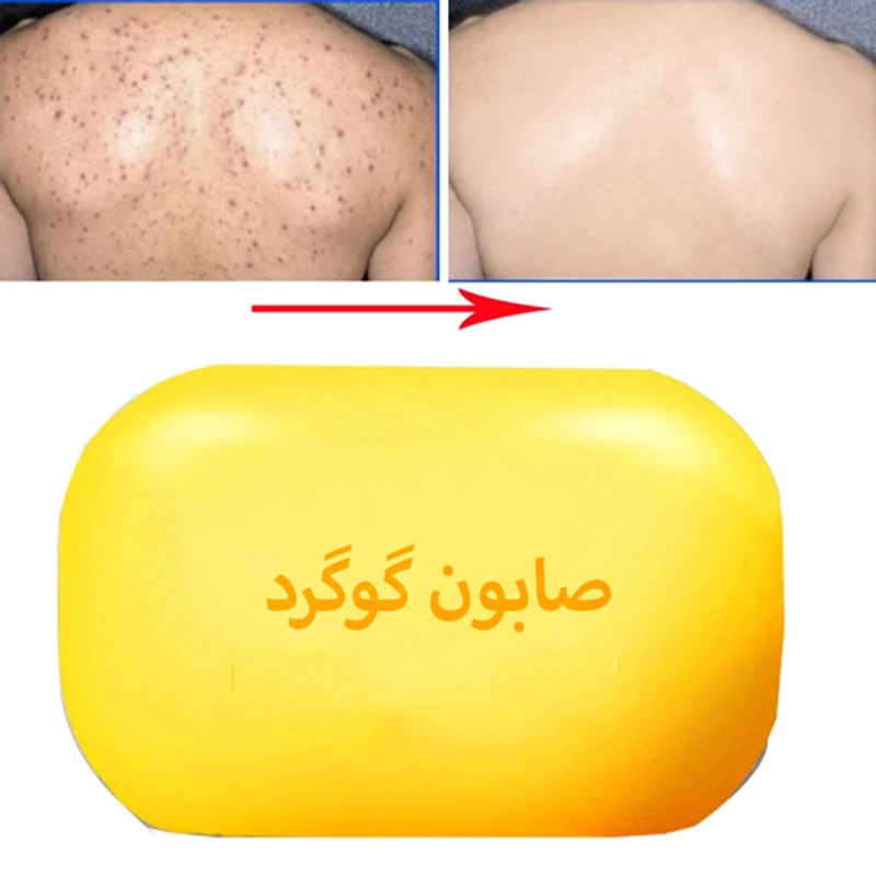 صابون گوگرد ضد جوش اژه